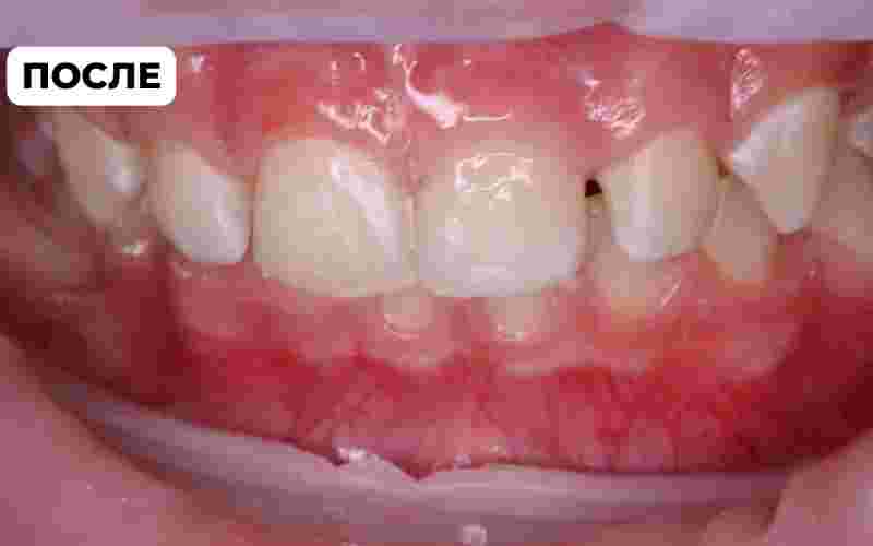 Восстановление зуба ребенку | Стоматологический центр АПРЕЛЬ