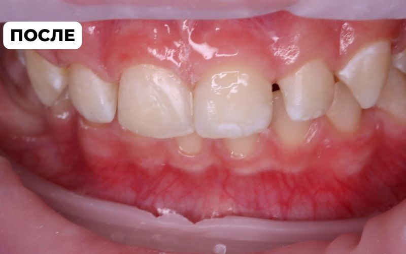 Восстановление зуба ребенку | Стоматологический центр АПРЕЛЬ