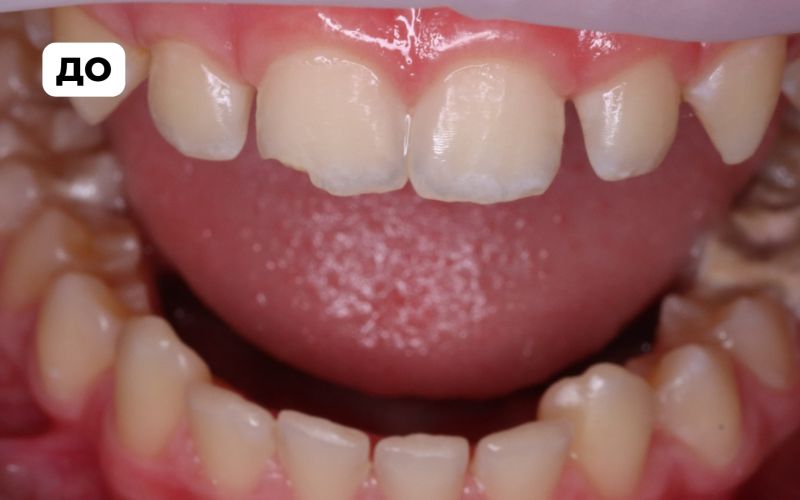 Восстановление зуба ребенку | Стоматологический центр АПРЕЛЬ