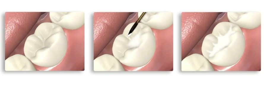 Герметизация фиссур зубов у детей