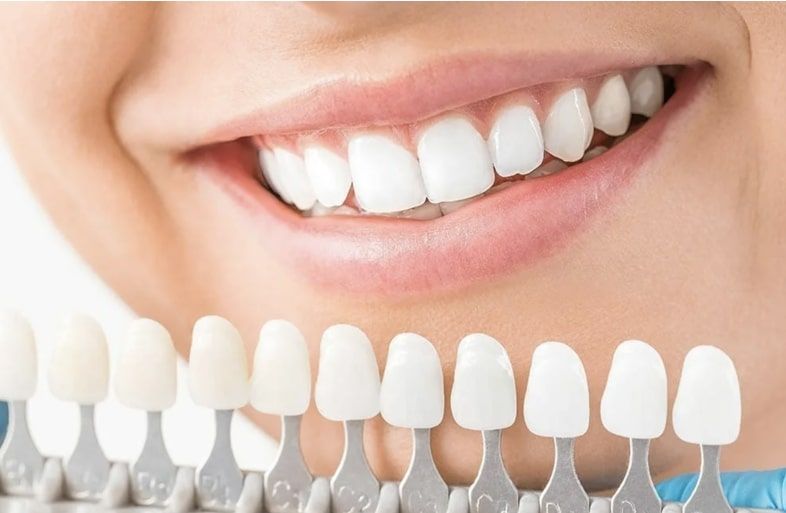 Керамические виниры