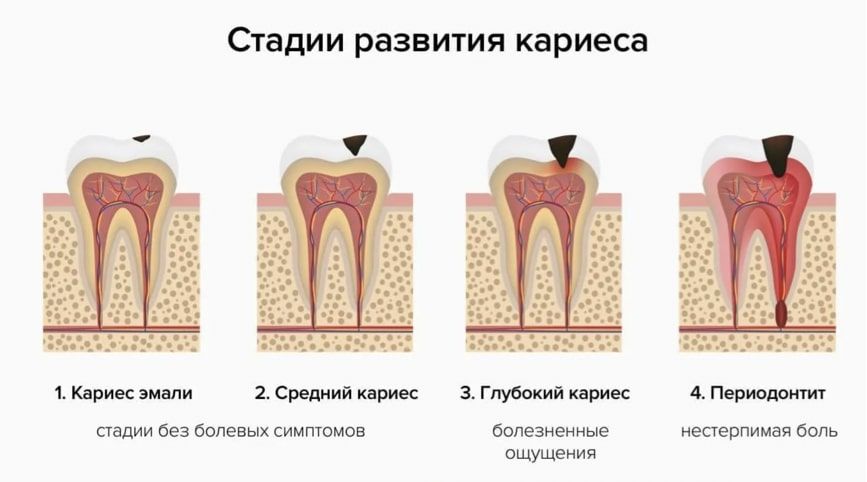 Лечение кариеса