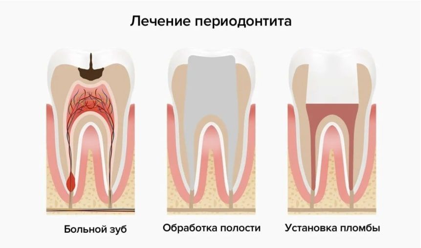 Лечение периодонтита