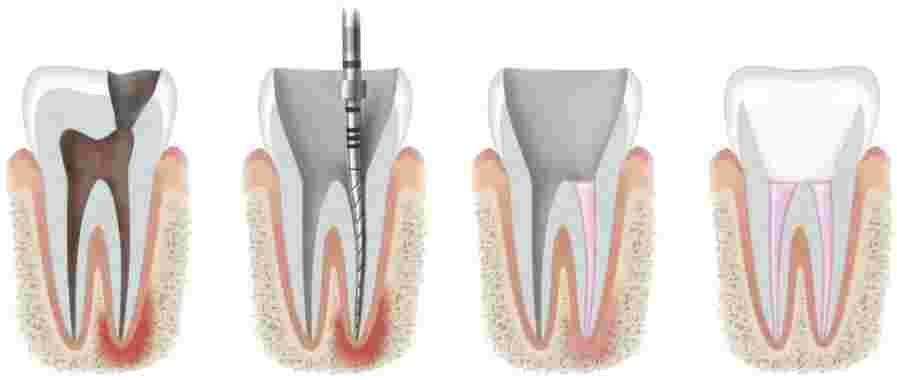 Пломбировка каналов зуба