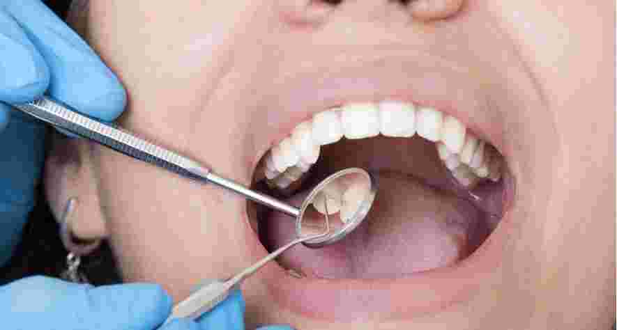 Пломбировка каналов зуба