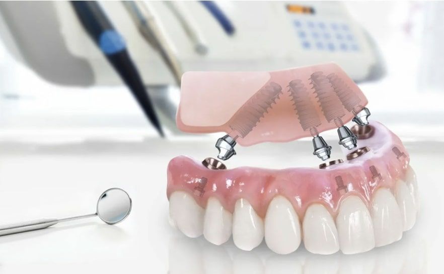 Протезирование зубов на имплантах