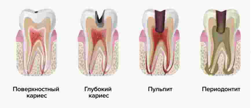 Лечение пульпита молочных зубов у детей