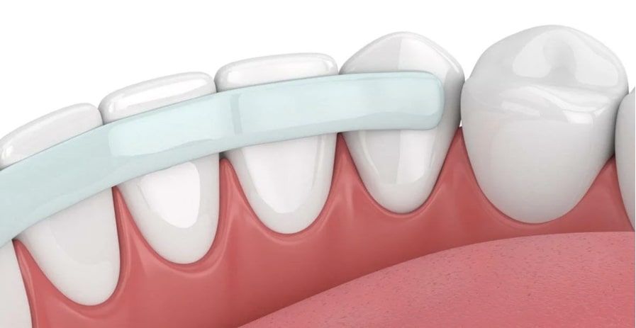 Шинирование зубов