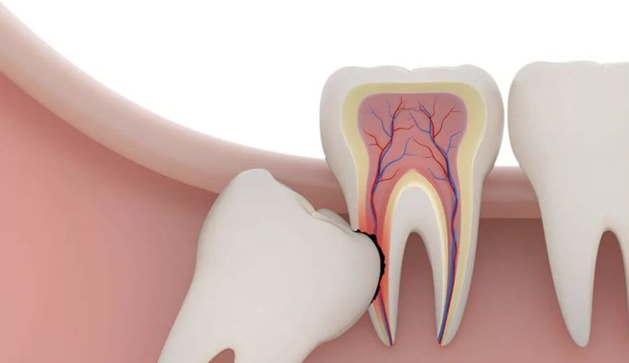 Удаление зуба мудрости