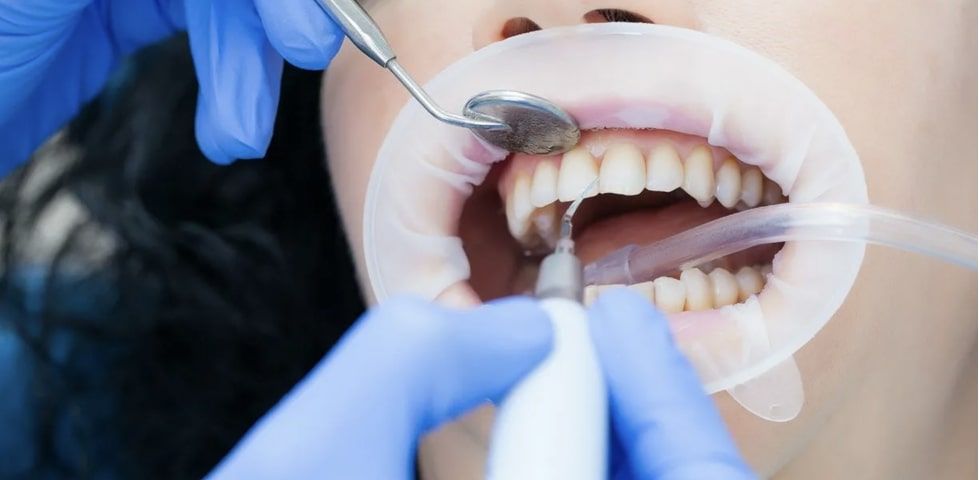 Ультразвуковая чистка зубов