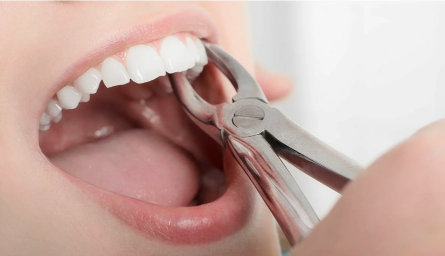 удаление зубов